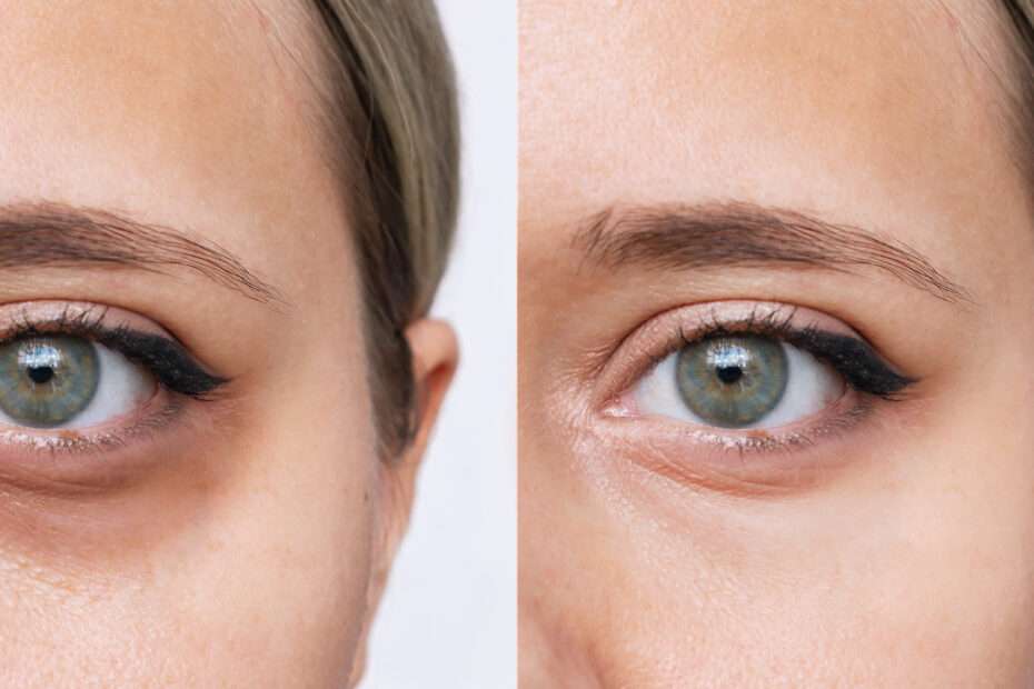 Behandlungen gegen Augenringe und Volumenverlust: